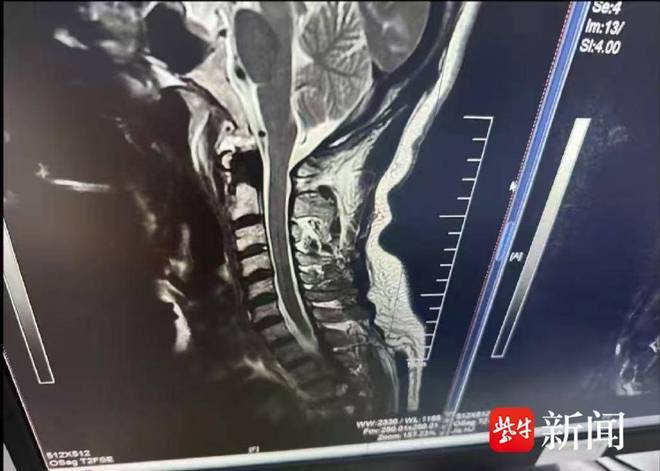 瘫确诊罕见病“冲浪者脊髓病”起诉赔偿200余万元j9九游会真人游戏第一小伙学冲浪“闪了腰”致截(图5)